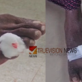 വാണിമേലിൽ തെരുവുനായ ആക്രമണം; നിരവധി പേർക്ക് പരിക്ക് 