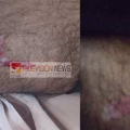 മഞ്ഞോടിയിൽ പെൻഷൻ വിതരണം ചെയ്യാനെത്തിയാ കലക്ഷന്‍  ഏജന്റിന് തെരുവുനായയുടെ കടിയേറ്റു