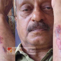 ചൂട് കൂടുന്നു; തലശ്ശേരിയിൽ വ്യാപാരിക്ക് സൂര്യാഘാതം, കൈക്ക് പൊള്ളൽ