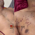 നീറ്റ് സമരക്കാർക്ക് നേരെ പെല്ലെറ്റ് പ്രയോഗിച്ചില്ലെന്ന വാദം പൊളിഞ്ഞു; യുവാവിന്റെ കണ്ണിൽ നിന്നും പെല്ലെറ്റുകൾ നീക്കം ചെയ്തു