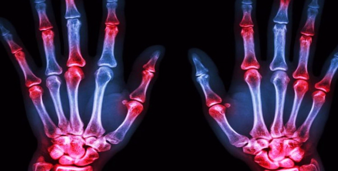 #Rheumatology |റുമറ്റോളജി വിഭാഗം:വടകര പാർകോയിൽ ഡോ: ബബിത മേക്കയിലിന്റെ സേവനം എല്ലാ ബുധനാഴ്ചകളിലും